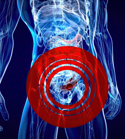 RECTAL SPACERS IN PROSTATE CANCER TREATMENT